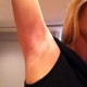 laser hair removal | armpit | Glow client