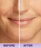Juvederm before & after pic