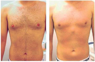 Men Hair Removal Tips: Waxing and Laser